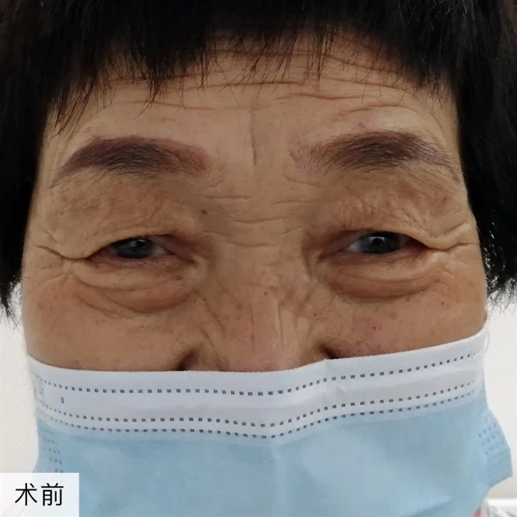 2Eye Wrinkle Elimination Recovery